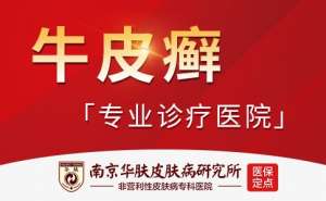 银屑病的症状表现“南京治疗银屑病比较好的医院是哪个医生”